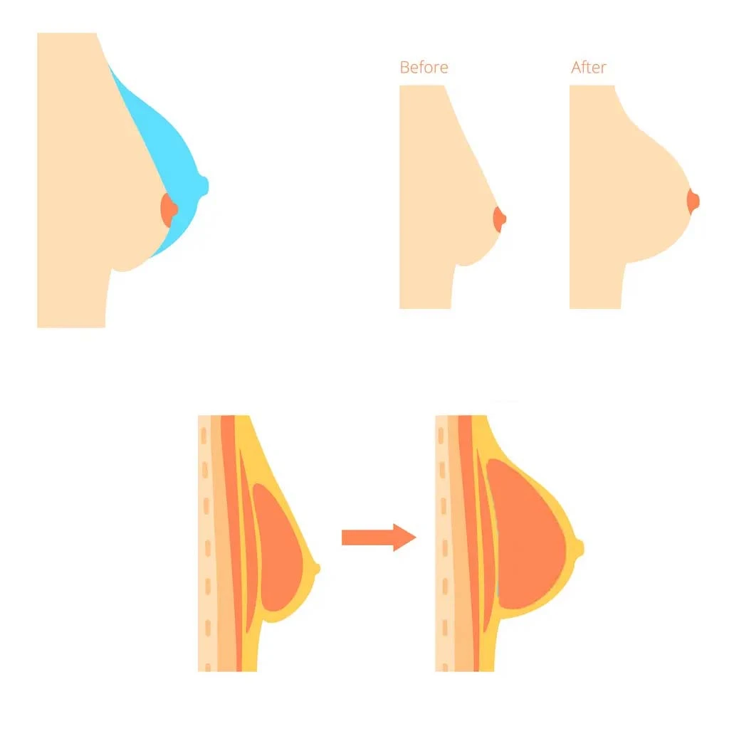 breast enhancement breast enhancement